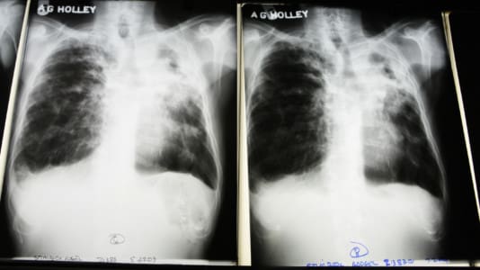 TB, tuberculosis